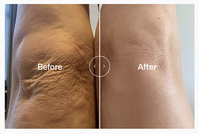 Lyma laser antes y después corporal