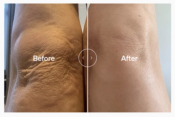 Lyma laser antes y después corporal