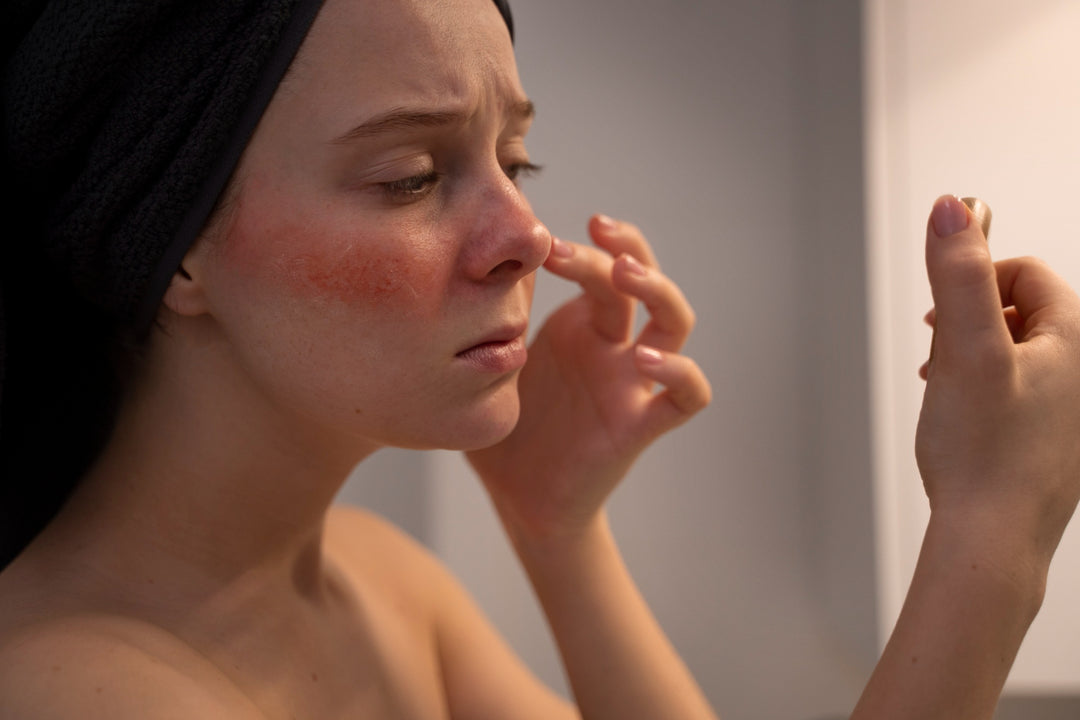 Piel con rosácea, consejos y cosméticos para tratarla