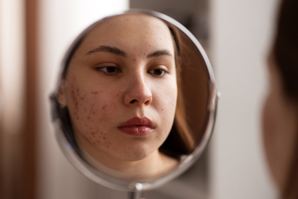 Mujer con acné: así son los cosméticos que tienes que usar