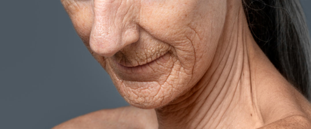 Mujer con elastosis solar