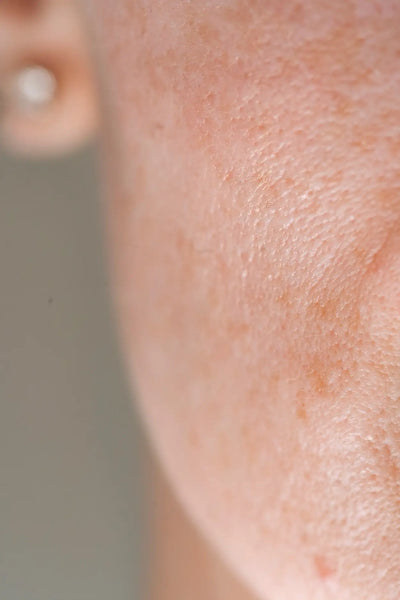 ¿Cómo tratar los poros dilatados respetando el cuidado de la piel?