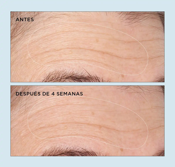 Imágen que enseña el frente de una usuaria de la crema Cold Plasma Plus Advanced Hydrating Complex antes y despues de 4 semanas de uso