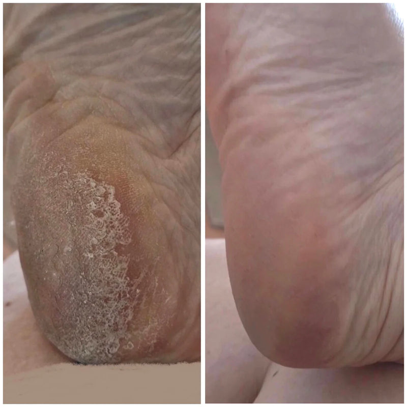 Antes y despues de Lova Skin Instant Foot Peeling