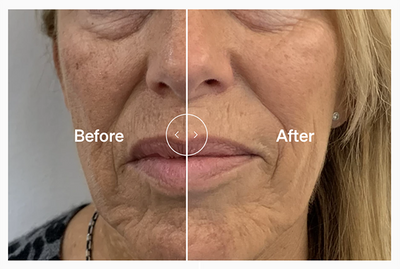 Lyma Laser facial antes y después