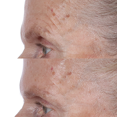 Perricone MD High Potency Face Finishing &amp; Firming Toner antes y después